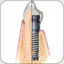 implant diagram