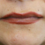 Lip Augmentation Case Study