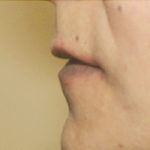 Lip Augmentation Case Study