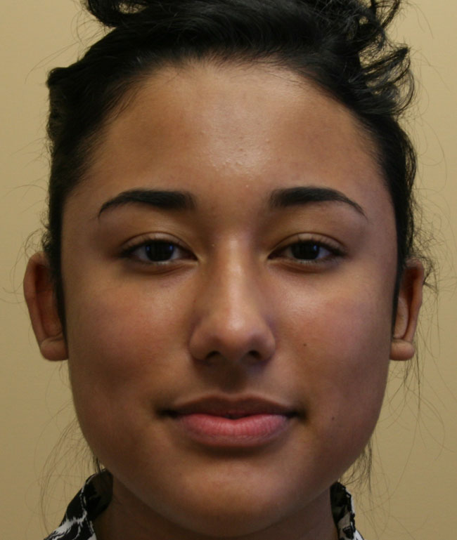 Otoplasty Case Study - Before