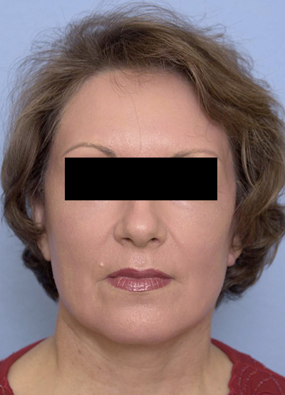Face lift, Brow lift, CO2 laser after
