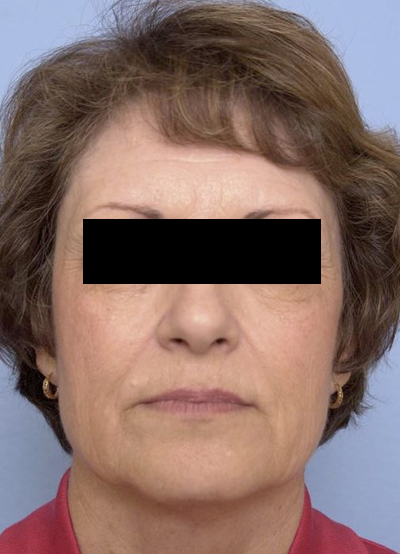 Face lift, Brow lift, CO2 laser before