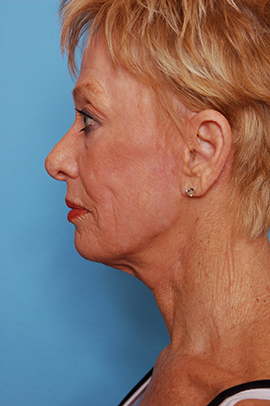 Face, Neck, Brow Lift and Co2 Laser Case Study After