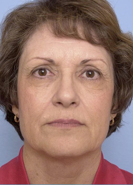 Face, Neck, Brow Lift and Co2 Laser Case Study Before