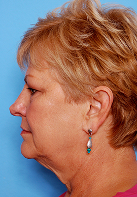 Face and Neck Lift Case Study Before